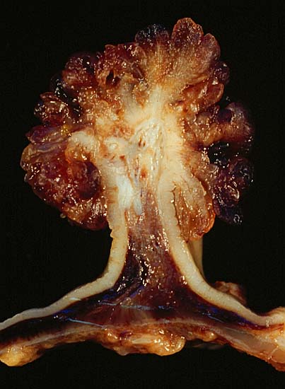 Polyp Kolon